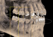 Implantate, Zahnärzte Nürnberg - 3D-Röntgendiagnose