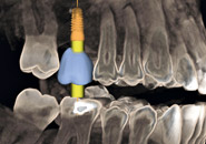 Implantate, Zahnärzte Nürnberg - Navigationsgestützte Implantologie