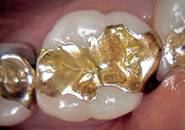 Inlays - Einlagefüllungen als Zahnersatz aus qualitativen Materialien wie Gold oder Keramik