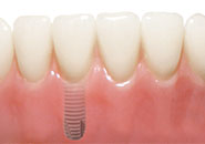 Zahnarzt Nürnberg Implantat Keramik
